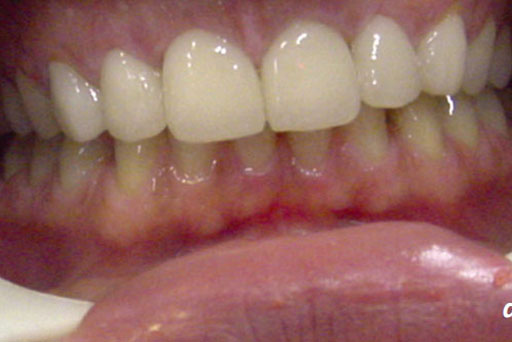 9.1. All Ceramic Restorations