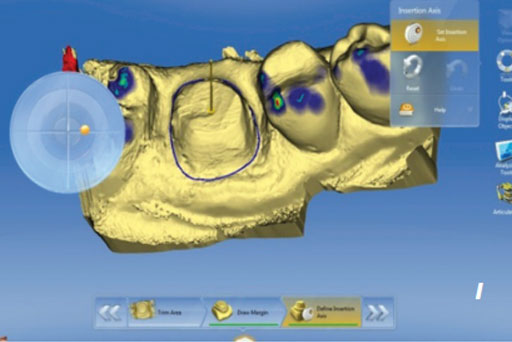 9.2. CAD-CAM ve freze teknolojisi