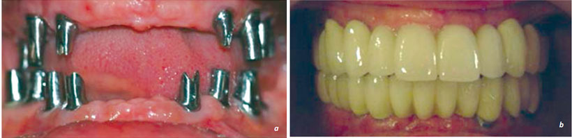 Resim 13-31 implant destekli protezler