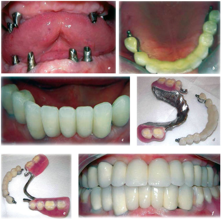 Resim 13.32 İmplant uygulamaları