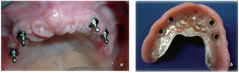 Resim 13.35. Overdenture implant destekli protez