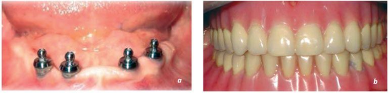 Resim 13.37. Overdenture tarzı implant destekli protez