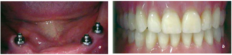 Resim 13.38. Overdenture tarzı implant destekli protez