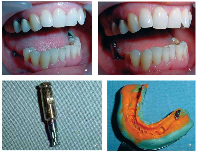 Resim 13.41 a, b- implant destekli protezlerde ölçü.