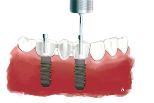 13.11. Destek (Abutment) Seçimi